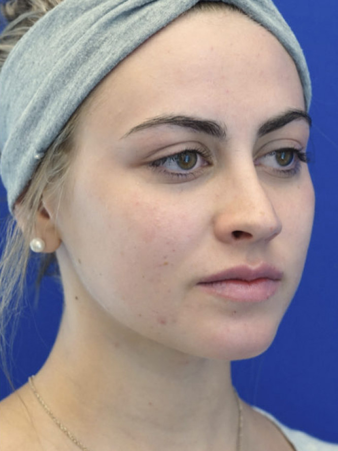 Smooth Dorsal Contour — After
