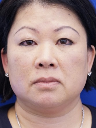 Asian Blepharoplasty — Before