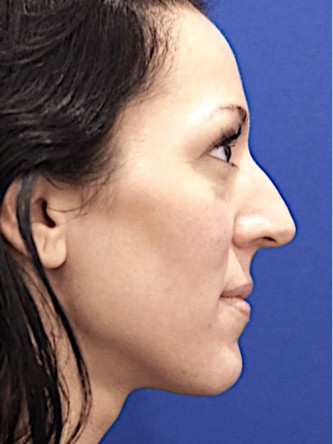 Hump Down Rotate Tip Up — Before