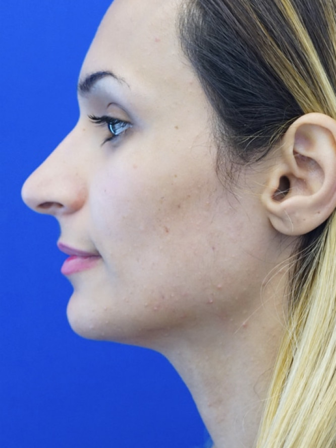Nasal Deviation and Dainty Tip — Before