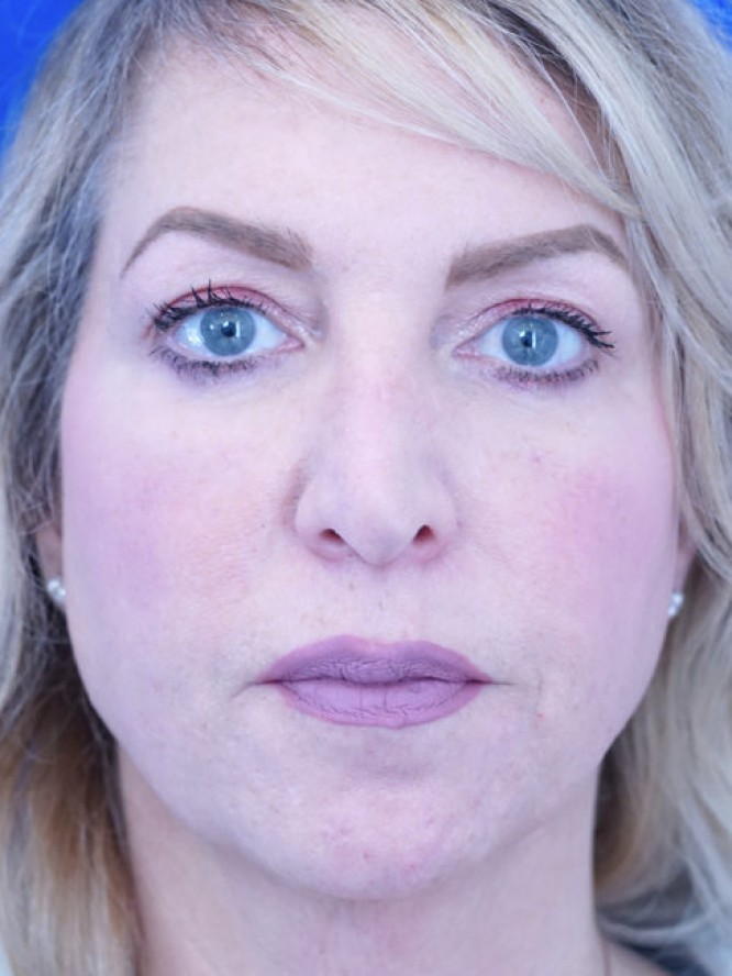 Tip Ptosis — Before