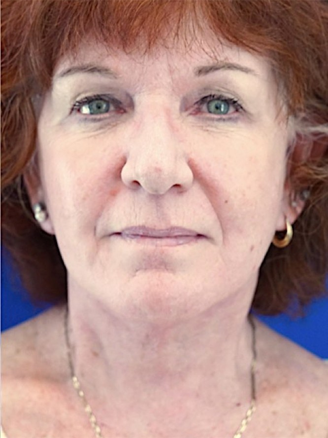 Neck Loose Skin — After