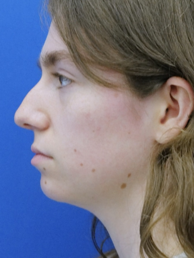 Preservation Rhinoplasty1 — Before