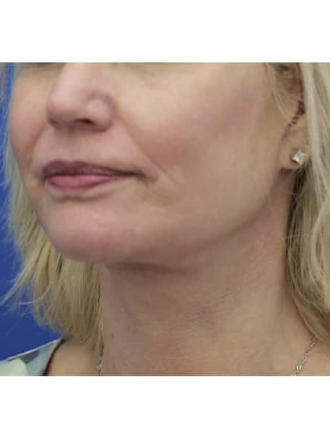 Crisp Profile Lines — After