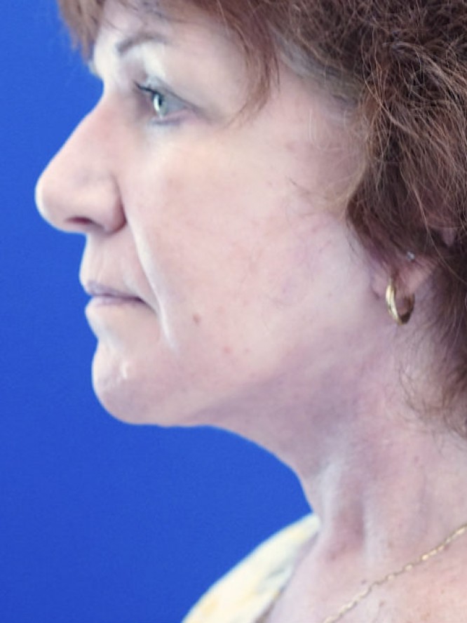 Neck Loose Skin — After