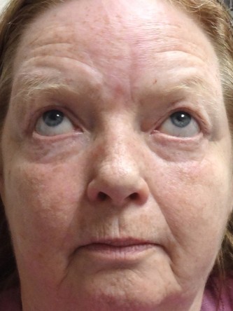 Visual Field Deficit – Eyelid Excess Skin4* — After