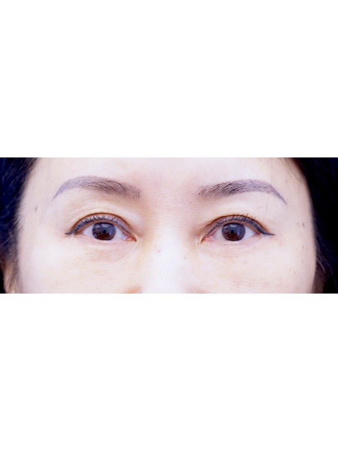 Lower Blepharoplasty with Fat Repositioning — After