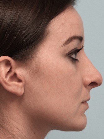 Droopy Tip – Revision* — Before