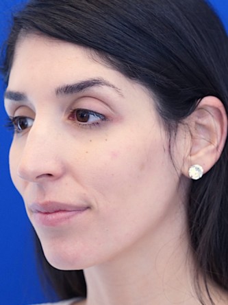 Nasal Bridge Bump* — Before