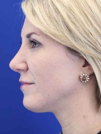 Aesthetic Nasal Contour* — After