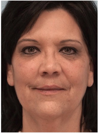 Radiesse to Malar Cheek and Laugh Lines* — After