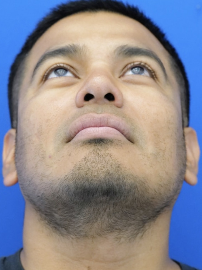 Rhinoplasty Trifecta — After