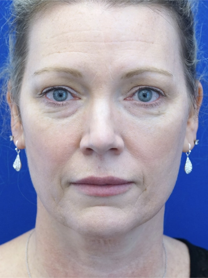 Cosmetic Eyelid Surgery — Before
