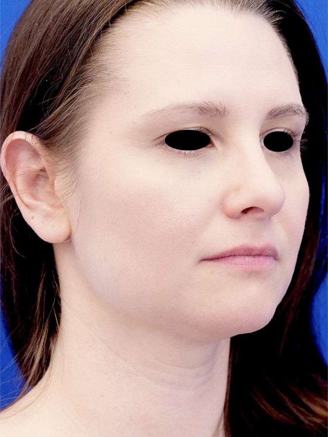 Nasal Aesthetic Nuances — After