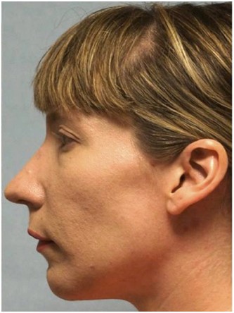 Chin Implant* — After