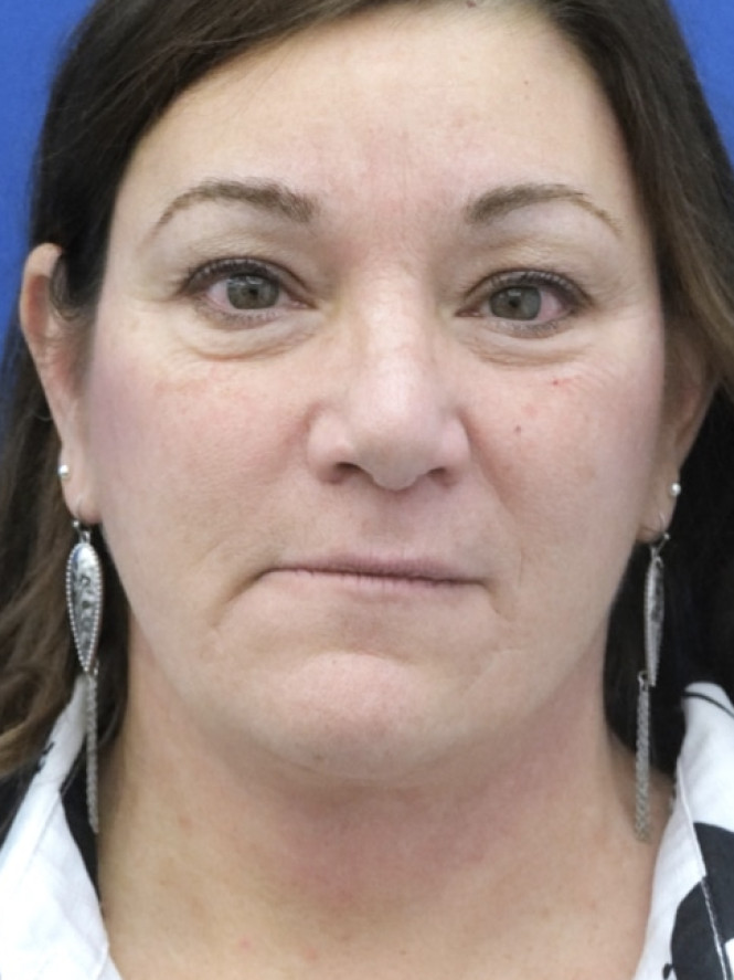 Full Upper and Lower Facelift — After