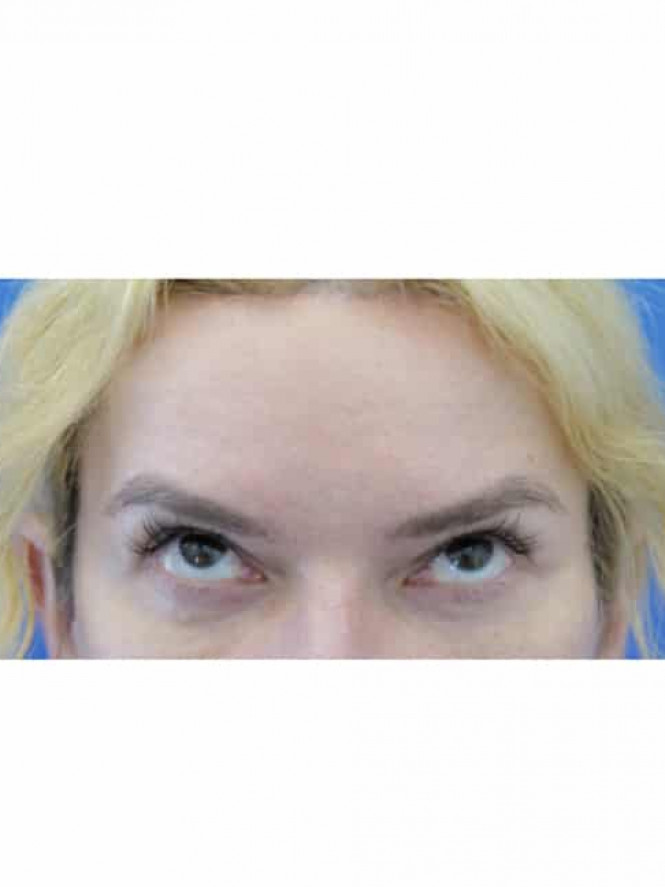 Cat Eye Blepharoplasty Browlift — After