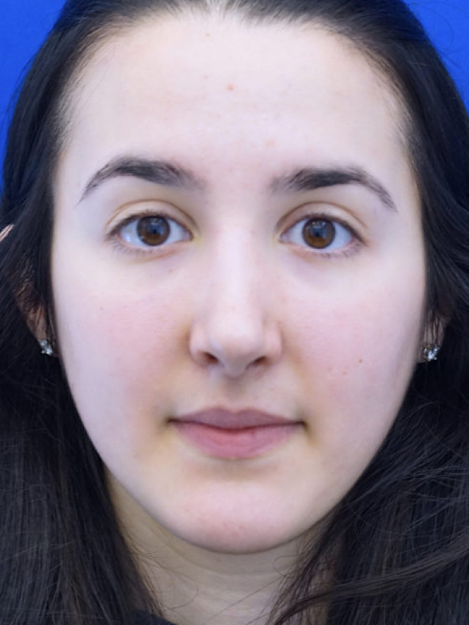 Endonasal Finesse Rhinoplasty — After