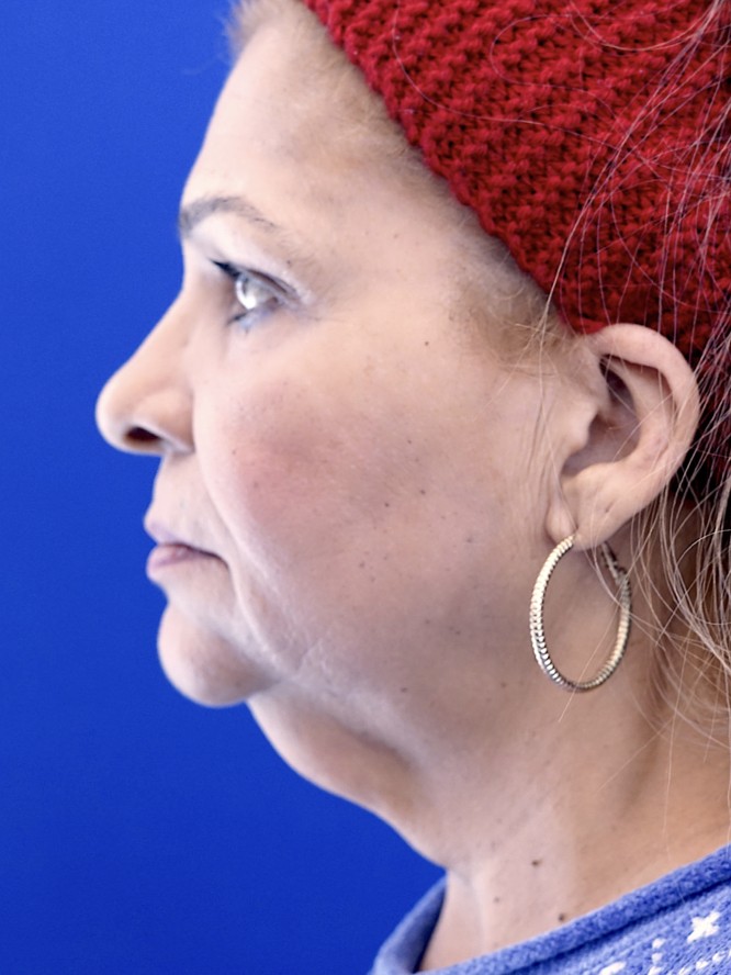 Necklift and Liposuction — Before