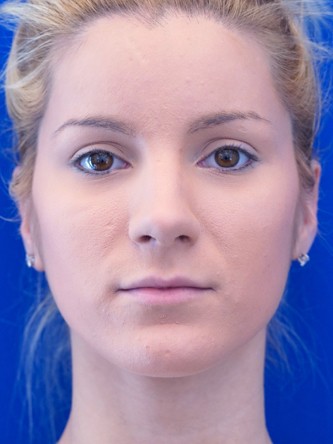 Restylane Silk Highlights Beautiful Lips* — Before