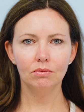 Radiesse to Nasolabial Folds* — After