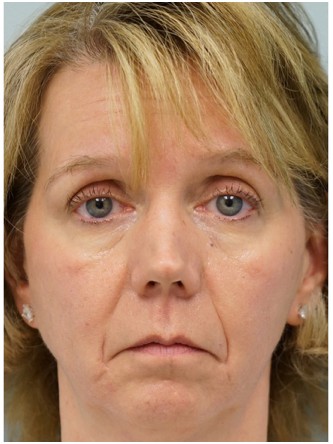 Radiesse to Lower Face* — Before