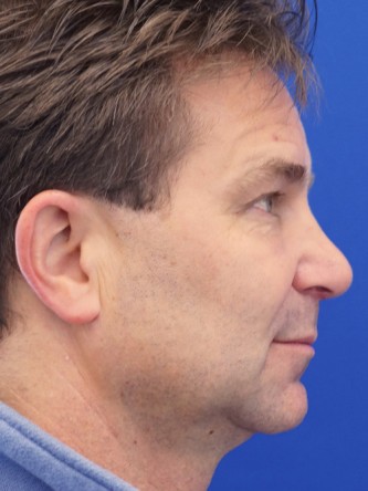Nasal Tip Droop* — After