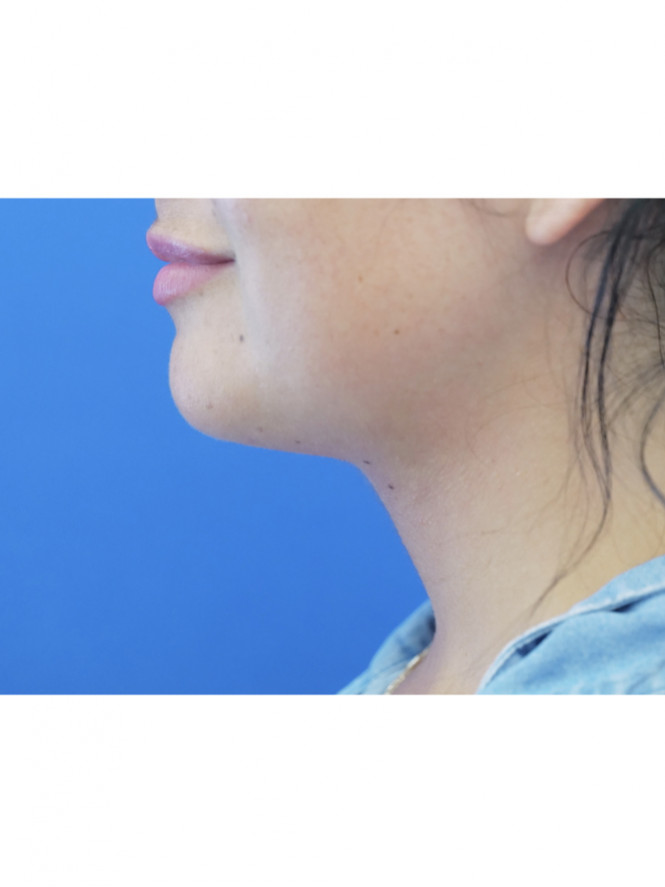 Platysmaplasty Without Skin Resection — After