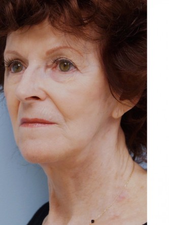 Facelift, Necklift, Platysmaplasty, ERB:YAG Laser Resurfacing* — After
