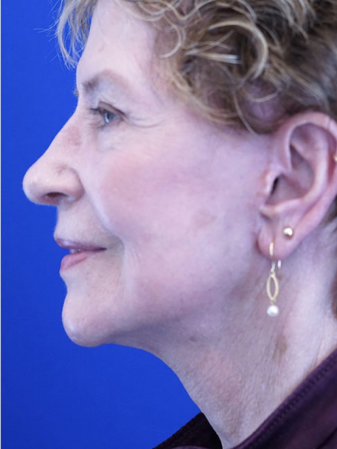 Deep Plane Facial Rejuvenation — After