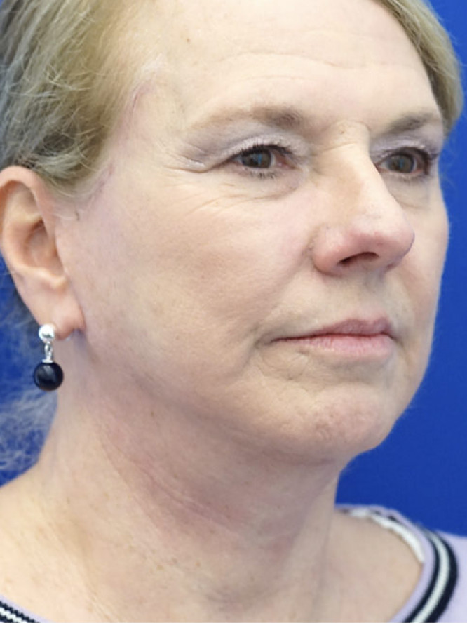 Lower Facial Aging and Fullness — After