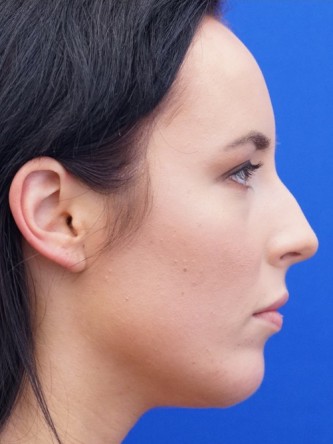 Chin Implant and Upper Lip Filler* — After