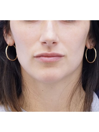 One Year Lip Filler Result — After