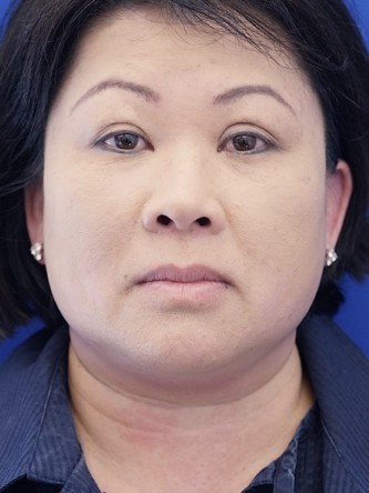 Asian Blepharoplasty — After