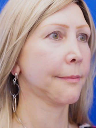 Revision Chin Implant, Mini Lift* — After