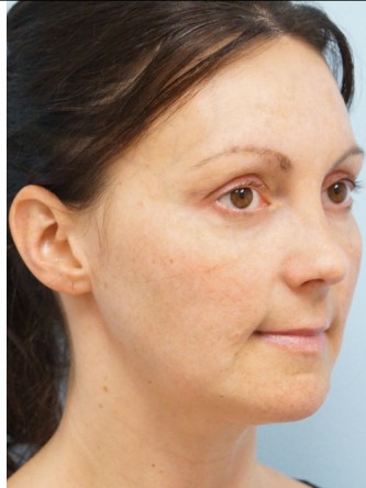Fractional CO2 Laser Skin Resurfacing2* — Before