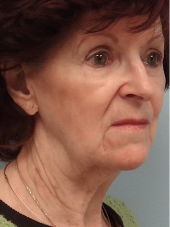 Facelift, Necklift, Platysmaplasty, ERB:YAG Laser Resurfacing* — Before