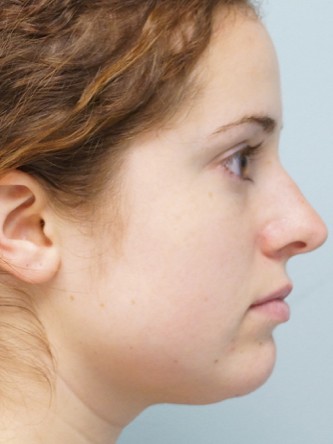 Crooked Nose Endonasal Technique1* — Before