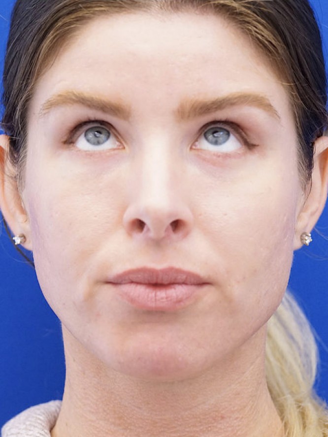 Lower Eyelid Skin Laxity — After
