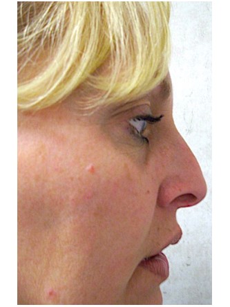 Mild Dorsal Hump & Droopy Tip2* — Before