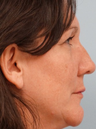 Juvederm to Upper Lip* — After