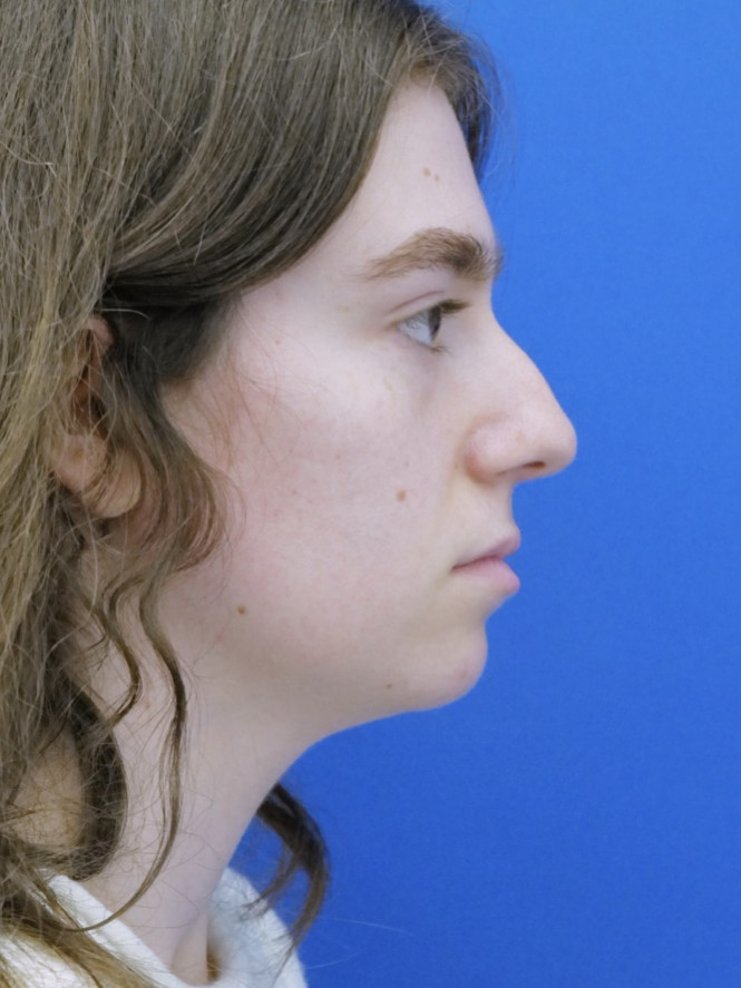 Preservation Rhinoplasty1 — Before