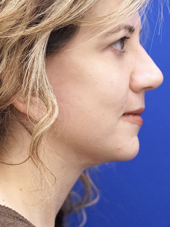 Deep Plane Face Lifting — After