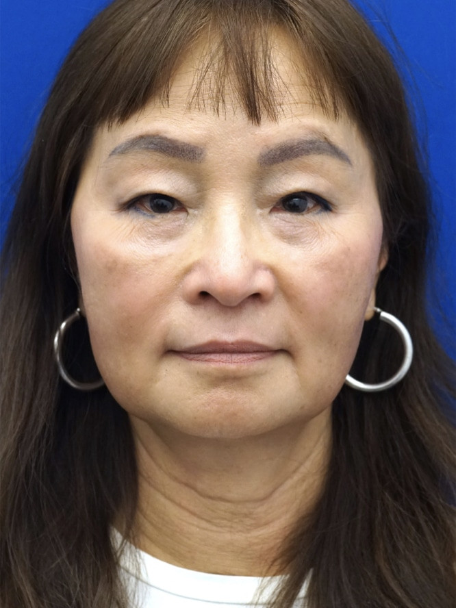 Asian Upper Eyelid Rejuvenation — Before
