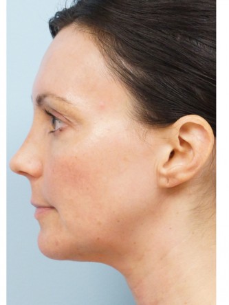 Fractional CO2 Laser Skin Resurfacing2* — After