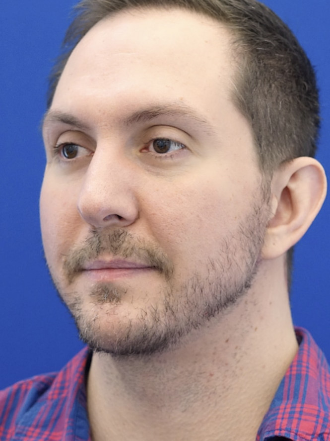 Lower Facial Contouring — After