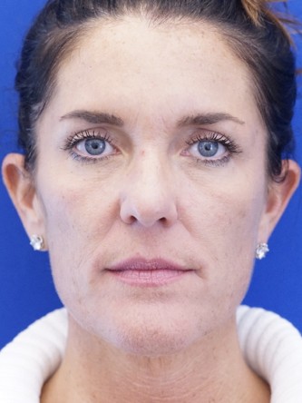 Upper Skin Only Blepharoplasty — After