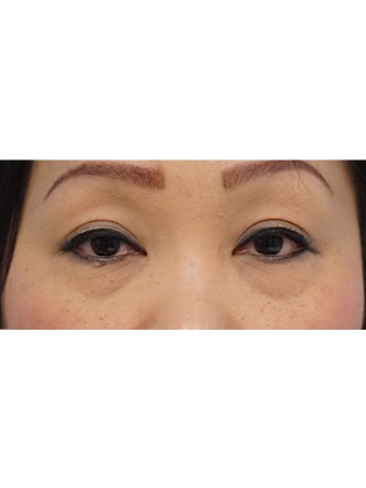 Lower Eyelid Fat Pseudoherniation* — Before