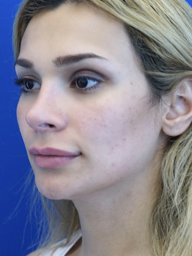 Nasal Deviation and Dainty Tip — After