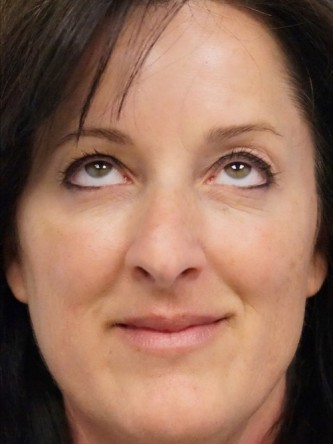 Botox Periorbital – Around the Eyes* — After